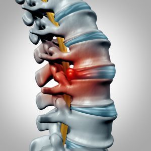 lumbar disc disease