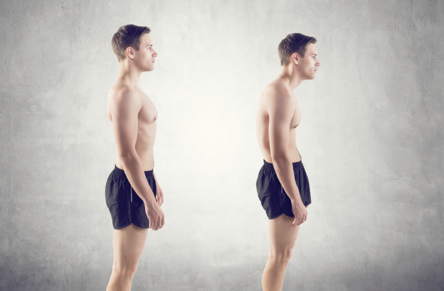 Upper Crossed Syndrome Chiropractor